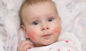 Ein Baby mit roten Wangen, das neugierig in die Kamera blickt. Die Haut auf den Wangen ist gerötet und leicht schuppig.