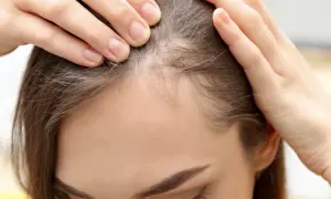 Frauenhände prüfen die Kopfhaut, wo feine baby haare wachsen.
