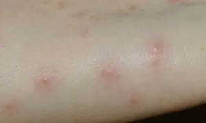 Rote, juckende Pusteln auf heller Haut, typisch für Grasmilben bei einem Kind nach dem Spielen im Freien.