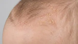 Nahaufnahme der Kopfhaut eines Babys mit trockener Haut und Schuppen.