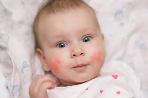 Ein Baby mit roten Wangen, das neugierig in die Kamera blickt. Die Haut auf den Wangen ist gerötet und leicht schuppig.