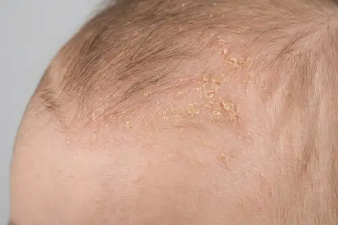 Nahaufnahme der Kopfhaut eines Babys mit trockener Haut und Schuppen.