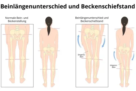 Vergleich von normaler Beckenstellung und Beckenschiefstand bei einem Kind. Ein Beckenschiefstand kann zu einem Beinlängenunterschied führen.