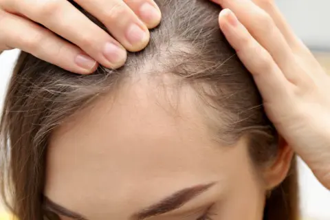 Frauenhände prüfen die Kopfhaut, wo feine baby haare wachsen.