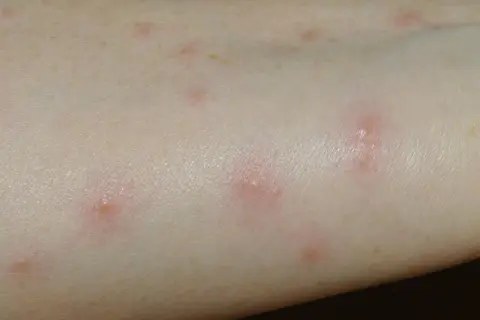 Rote, juckende Pusteln auf heller Haut, typisch für Grasmilben bei einem Kind nach dem Spielen im Freien.