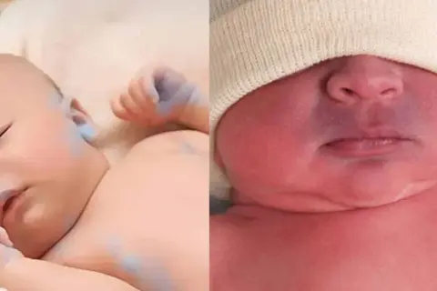 Zwei Neugeborene, eines mit bläulichen Flecken auf der Haut, das andere mit rötlicher Haut und blauen Lippen, ein Zeichen von Zyanose.
