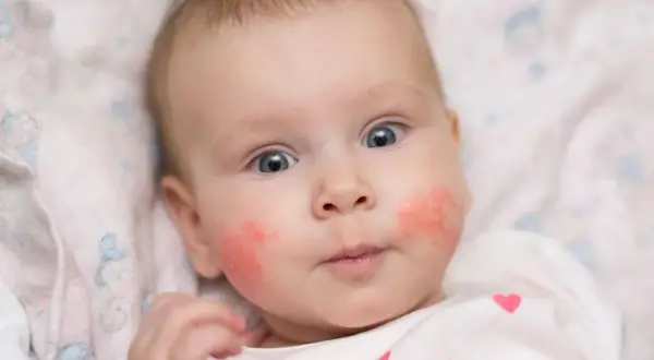 Ein Baby mit roten Wangen, das neugierig in die Kamera blickt. Die Haut auf den Wangen ist gerötet und leicht schuppig.