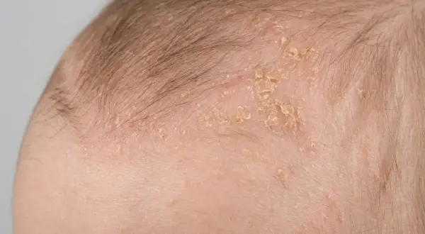 Nahaufnahme der Kopfhaut eines Babys mit trockener Haut und Schuppen.