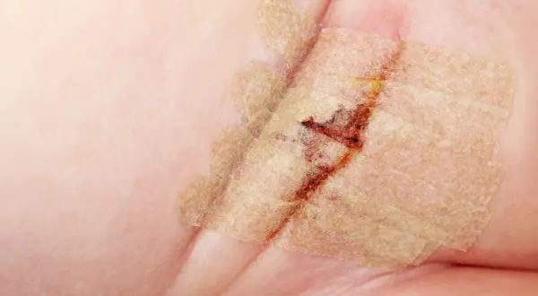 Nahaufnahme einer Wunde mit Pflaster, die auf einen Leistenbruch bei einem Baby hindeutet. Heilungsprozess nach der Operation.