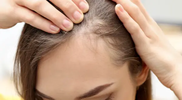 Frauenhände prüfen die Kopfhaut, wo feine baby haare wachsen.