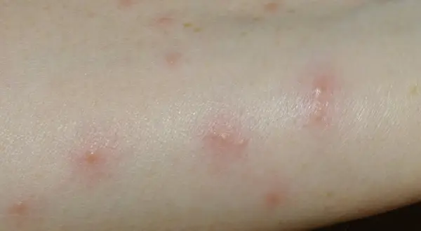 Rote, juckende Pusteln auf heller Haut, typisch für Grasmilben bei einem Kind nach dem Spielen im Freien.
