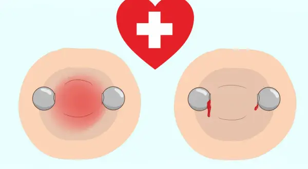 Rote Brustwarzen mit Piercings, eine entzündet, die andere blutet. Ein rotes Herz mit weißem Kreuz darüber. Vorsicht beim Stillen mit Nippelpiercing.