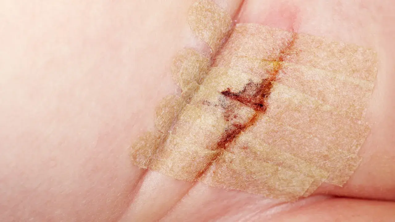 Nahaufnahme einer Wunde mit Pflaster, die auf einen Leistenbruch bei einem Baby hindeutet. Heilungsprozess nach der Operation.