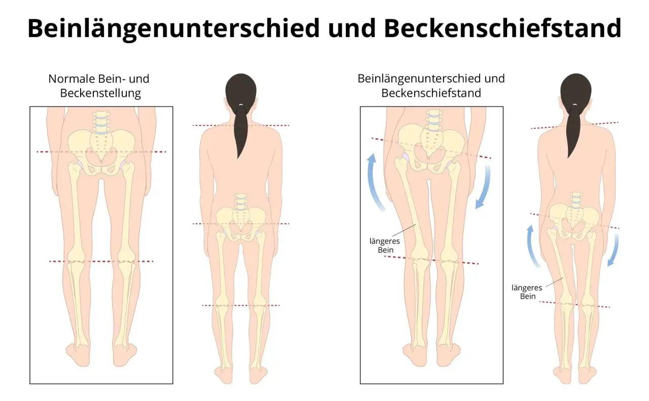 Vergleich von normaler Beckenstellung und Beckenschiefstand bei einem Kind. Ein Beckenschiefstand kann zu einem Beinlängenunterschied führen.