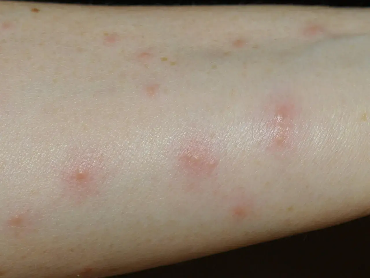 Rote, juckende Pusteln auf heller Haut, typisch für Grasmilben bei einem Kind nach dem Spielen im Freien.