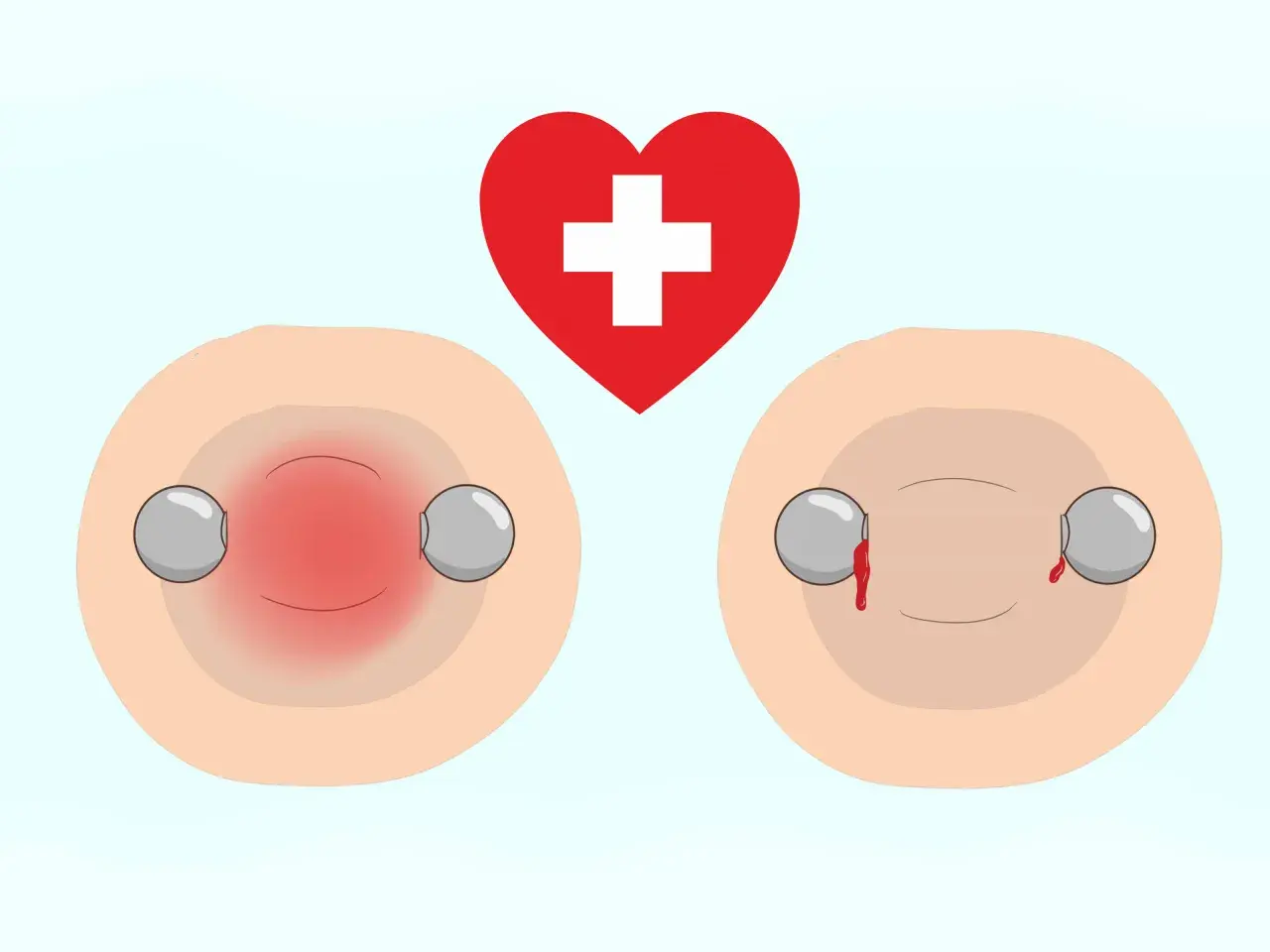 Rote Brustwarzen mit Piercings, eine entzündet, die andere blutet. Ein rotes Herz mit weißem Kreuz darüber. Vorsicht beim Stillen mit Nippelpiercing.
