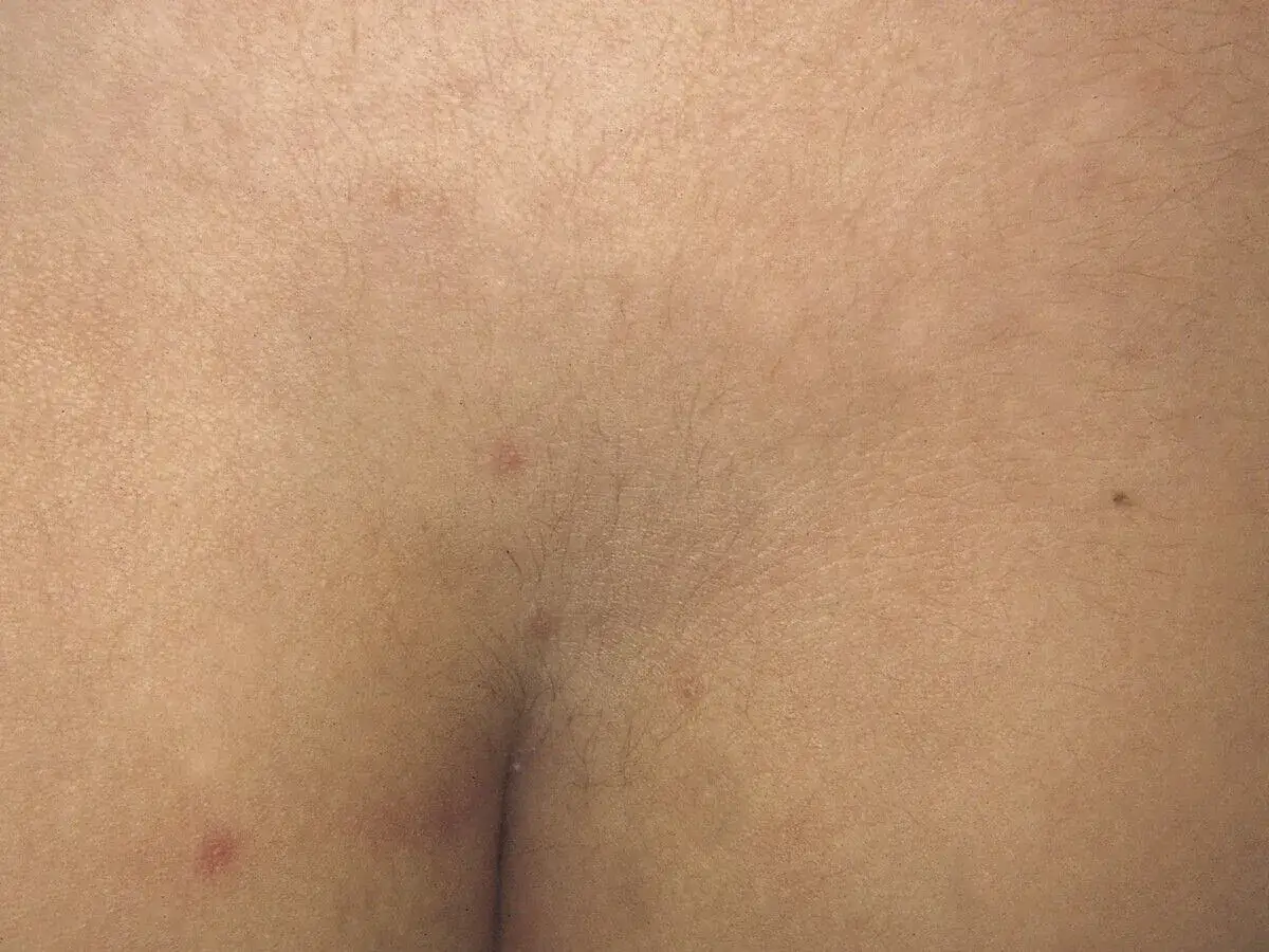 Haut eines Babys mit einem typischen mongolenfleck. Kleine rote Flecken sind ebenfalls sichtbar.