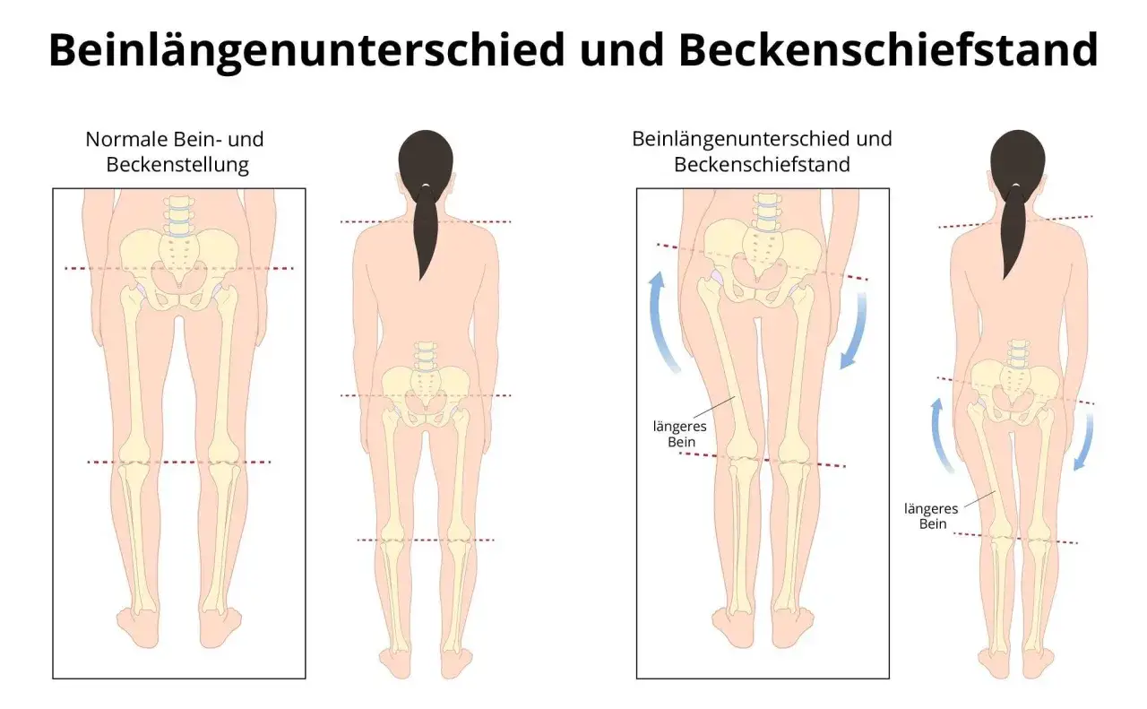 Vergleich von normaler Beckenstellung und Beckenschiefstand bei einem Kind. Links: gerade Beine, gerade Beckenlinie. Rechts: Beckenschiefstand mit einem längeren Bein.