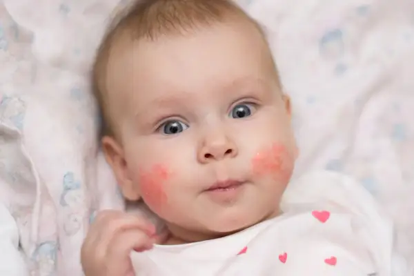 Ein Baby mit roten Wangen, das neugierig in die Kamera blickt. Die Haut auf den Wangen ist gerötet und leicht schuppig.
