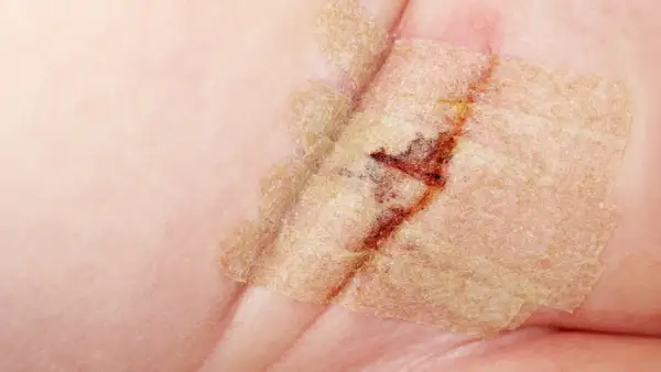 Nahaufnahme einer Wunde mit Pflaster, die auf einen Leistenbruch bei einem Baby hindeutet. Heilungsprozess nach der Operation.