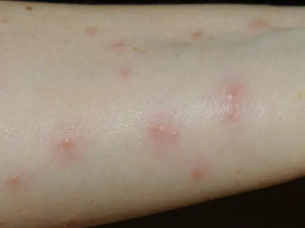 Rote, juckende Pusteln auf heller Haut, typisch für Grasmilben bei einem Kind nach dem Spielen im Freien.